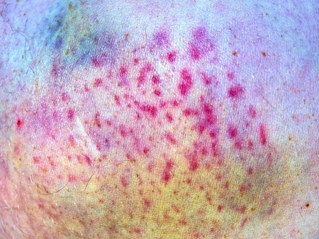 Large bruise on wounded man leg skin laying in hospital bed. Colorful huge  bruise on the male leg