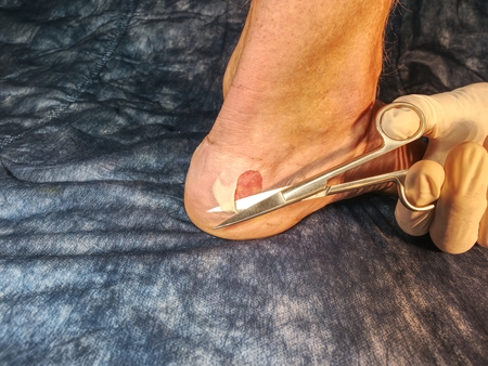 Nurse cleaning dead skin on patient leg with spike scissors, blue sterile background.  Deep...