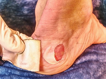 Blister from wrong boots and infection wound in the foot skin  of patients.の写真素材
