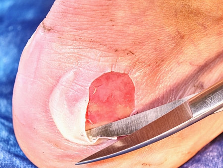 Nurse cleaning dead skin on patient leg with spike scissors, blue sterile background.  Deep...