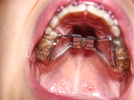 Kid wearing orthodontic palatal expanding trainer. Invisible braces aligner. Popular orthodontic appliance for birth dental deffectの写真素材