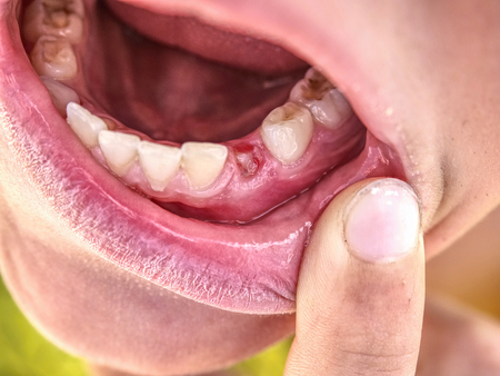 Lost canine tooth boy.  Little boy showing that he lost first milk canine toothの写真素材