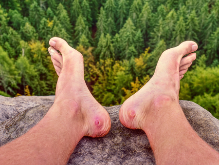 Close up on Blister on foot of a male. Hurt hikers legs without shoes. Misty morning fall nature. Outdoor activitiesの写真素材