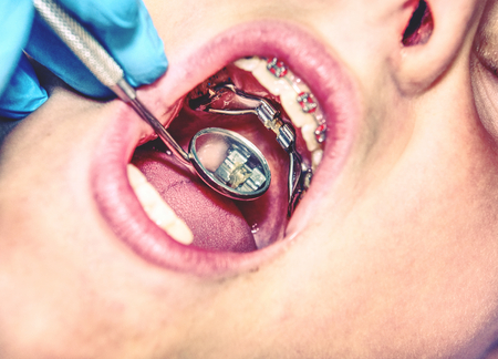 Patient with  dental braces during check or  treatment, dental mirror dentist tools side view.の写真素材