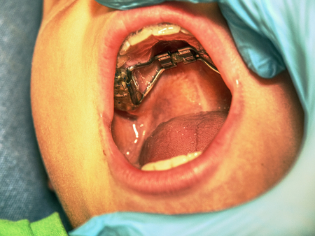 The Hyrax (Hygienic Rapid Expander) Banded designed as an upper arch rapid palatal expanding appliance.の写真素材