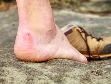 Close up on Blister on foot of a male. Hurt hikers legs without shoes. Misty morning fall nature. Outdoor activitiesの写真素材