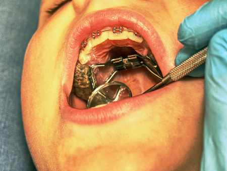 Prague, Czech Republic September 28th 2018.  The Hyrax (Hygienic Rapid Expander) Banded designed as an upper arch rapid palatal expanding appliance.の写真素材