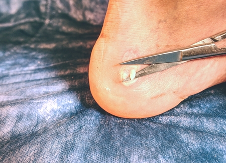Mediciman treat damaged skin on sportsman heel.  Nasty hot place of damaged skin near Achilles tendonの写真素材
