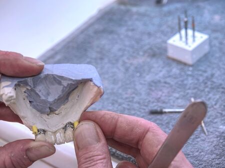 Metal-ceramic dental crown is tried on an gypsum model. Dental care concept. Human teeth with dentures on 3d modelの写真素材