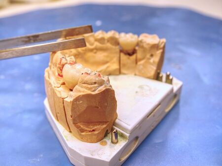 Plaster cast of human jaws. Dental casting gypsum model jaws in prosthetic laboratory. Dentistry,...