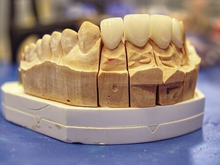 Ceramic-metal crowns and partial  ceramic-metal bridge. Replacement of artificial tooth. Orthopedic dentistry lab.の写真素材