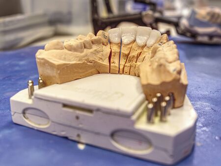 Ceramic highly aesthetic dental crown on gypsum model from labotary.の写真素材