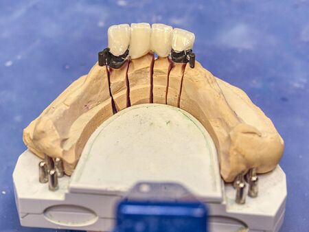 Metal ceramic dental crowns on artificial models. Dental prosthesis equipment and tools