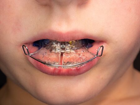 Teenage boy wearing orthodontic braces and showing tongue.  Teeth with orthodontic brackets. Dental...