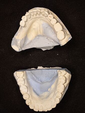Open gypsum jaws on table. Orthodontic teeth cast. Visualisation of jaws defects on colored plastic...