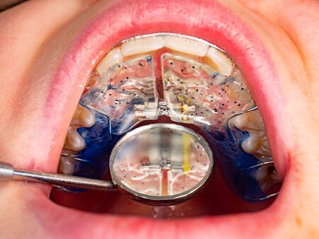 Dentist is check and set dimension of brackets. Talking to girl about braces in her mouthの写真素材