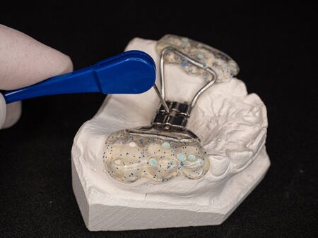 Detail of braces setting. Hyrax expand braces for patient teeth.  Plaster cast of the patients upper palate with congenital defects of the anterior teethの写真素材