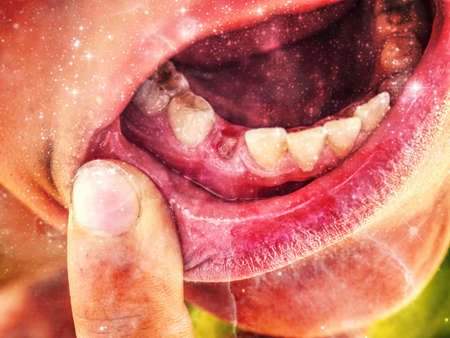 The vampire shows a missing tooth. Shifted colors of teenagers face, dental problem. Abstract.の写真素材