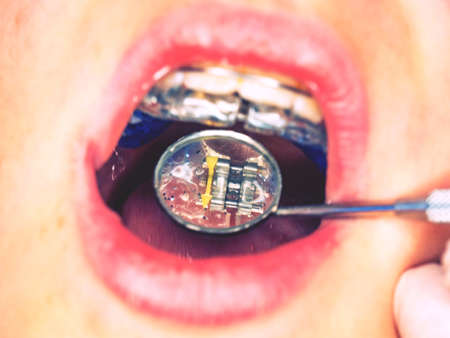 Doctor check setting of palatal braces for correction of birth defect. Child with orthodontic appliance.の写真素材