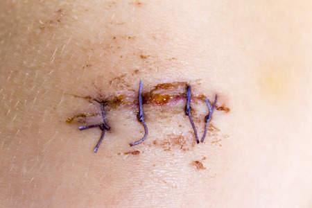 Cut wound with four sutures superimposed close upの写真素材