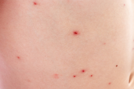Closeup view of caucasian boy skin with Varicella virus or Chickenpox, child with bubble rash. Dermatology and pediatrics conceptの写真素材