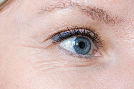 Woman face, eye wrinkles before treatment - the result of rejuvenating cosmetological procedures of biorevitalization, face lifting and pigment spots removalの写真素材
