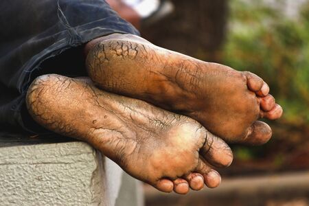Mans with dry and deeply cracked heels restingの写真素材