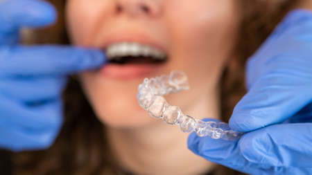 Orthodontist doctor in gloves putting silicone invisible transparent braces on woman's teeth in dentist clinic, mouth closeup view. Correcting teeth treatment and cure in dentistry.の写真素材