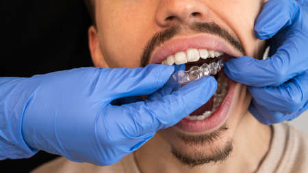 Man dentist in gloves applying invisible aligner on male patient teeth at modern clinic. Orthodontic...