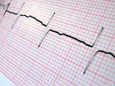           Ecg Printout