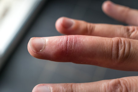 Mallet finger healing after splint removal from middle finger following joint traumaの写真素材