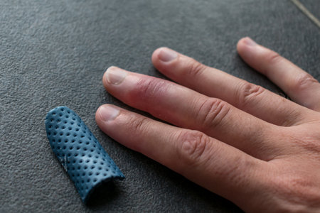 Mallet finger healing after splint removal from middle finger following joint trauma