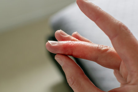 Mallet finger healing after splint removal from middle finger following joint traumaの写真素材