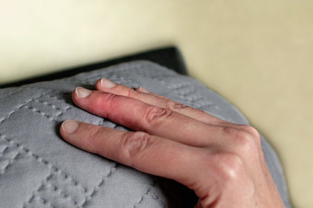 Mallet finger healing after splint removal from middle finger following joint traumaの写真素材