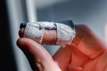 Mallet finger with custom orthosis on the middle finger to immobilize the last phalanx following...