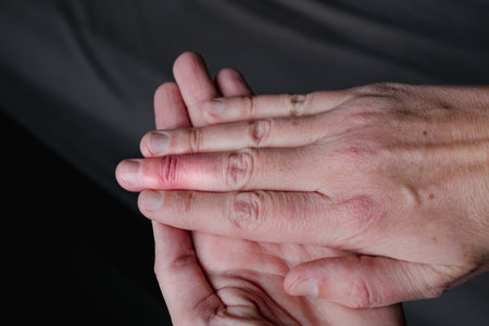Mallet finger healing after splint removal from middle finger following joint trauma