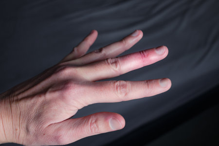 Mallet finger healing after splint removal from middle finger following joint traumaの写真素材