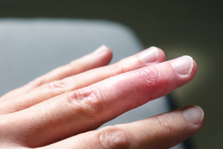 Mallet finger healing after splint removal from middle finger following joint traumaの写真素材