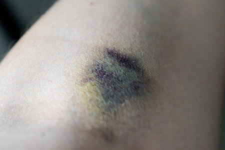 Bruise on arm after blood test, hematoma