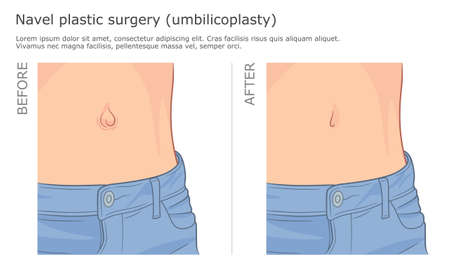 Umbilicoplasty : Belly Button Reconstruction l Belly Button Surgery – NQQA