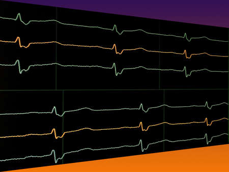 Bright lines electrocardiogram on the monitor 