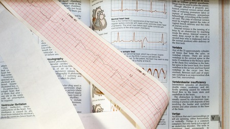 Stethoscope on the Electrocardiogram (ECG) , pen and note, Top view