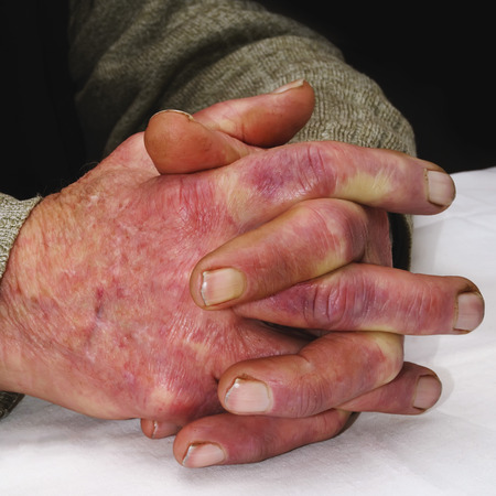 Closeup of the wrinkled hands of an old caucasian man, wearing a green sweater