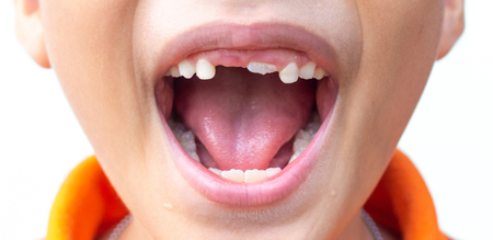Little boy show Broken teeth.boy with a broken and rotten teethの写真素材