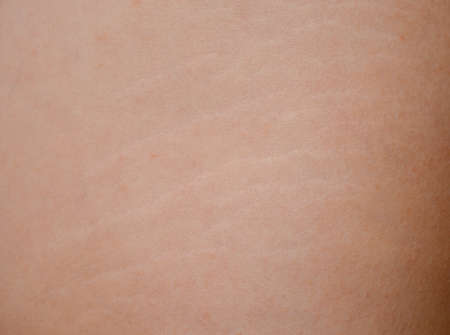 Close-up of stretch marks on the thigh and the texture of human skin.の写真素材