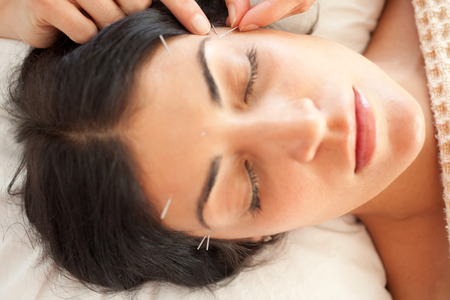acupuncture treatment - facial rejuvination therapy - alternative medicine