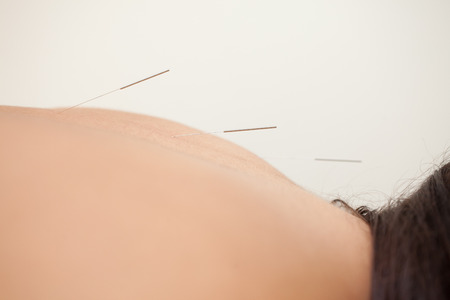 acupuncture therapy - alternative health careの写真素材