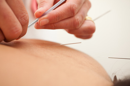 acupuncture therapy - alternative health careの写真素材