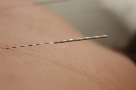 acupuncture needle - alternative therapyの写真素材