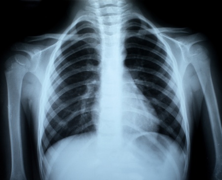 the xray photo of a human bonesの写真素材